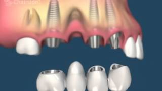 какие бывают ошибки при протезировании зубов
