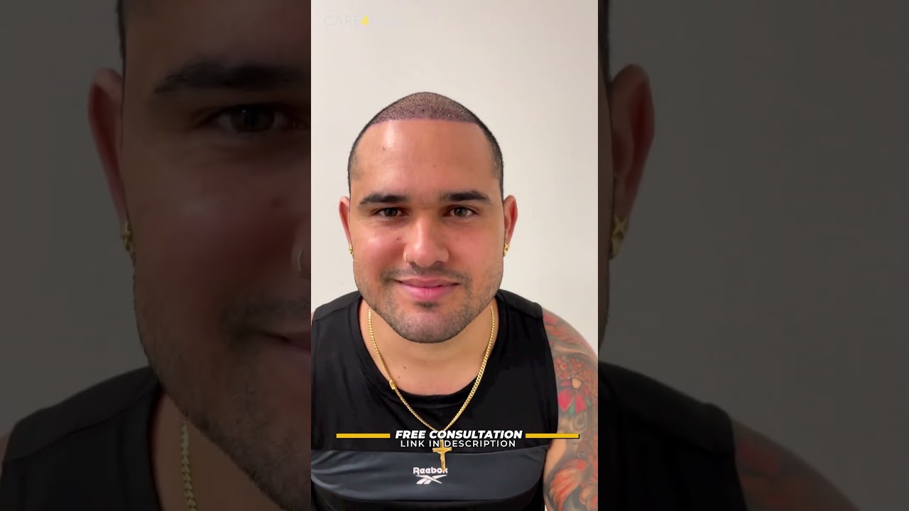 Hair Transplant: 7 days post-op