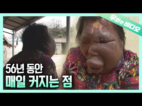 56년 평생, 얼굴 없이 살아온 여인┃A Woman <strong>Who</strong> Has Lived Without a <strong>Face</strong> for 56 Years