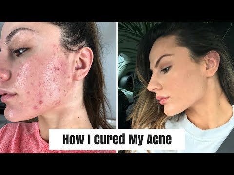 HOW I CURED MY ACNE | Skin care & REAL results