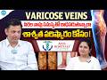 Avis Hospitals | సిరల వాపు సమస్య తో బాధపడుతున్నారా | Varicose Veins | Dr. Rajah V Koppala