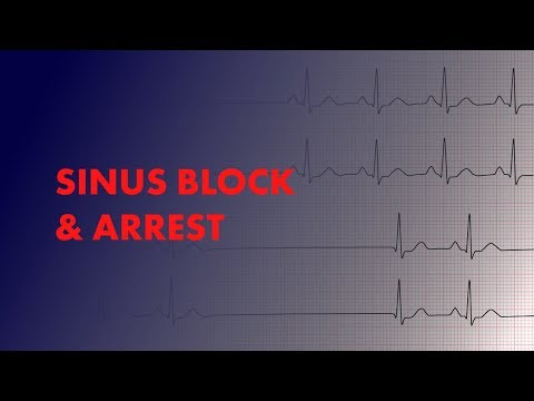 Sinus Block and Sinus Arrest - EKG (ECG) Interpretation