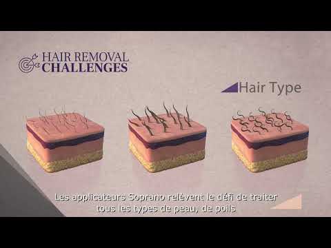 Epilation laser définitive - Soprano Titanium® - Clinique Clemenceau Lille et Arras