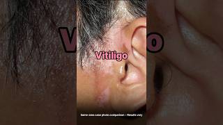 Vitiligo Repigmentation (Same Area) | Case Photo Comparison | Seoul