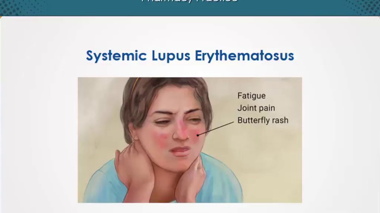 What Is Systemic Lupus Erythematosus Sle Quizlet
