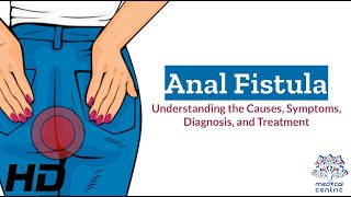 Anal Fistula Explained: Causes, Symptoms, and Treatment screenshot 5