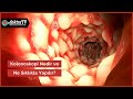 Kolonoskopi Nedir ve Kimlere Yapılır? | Kolonoskopi Nasıl Yapılır? | Prof.  Dr. Çetin Karaca