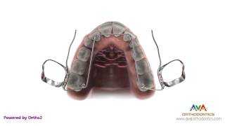 Orthodontic Expander or Spacer - Quad Helix Appliance