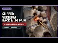 Spondylolisthesis Explained: What Patients and Residents Need to Know