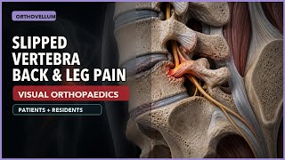 Spondylolisthesis Explained: What Patients and Residents Need to Know