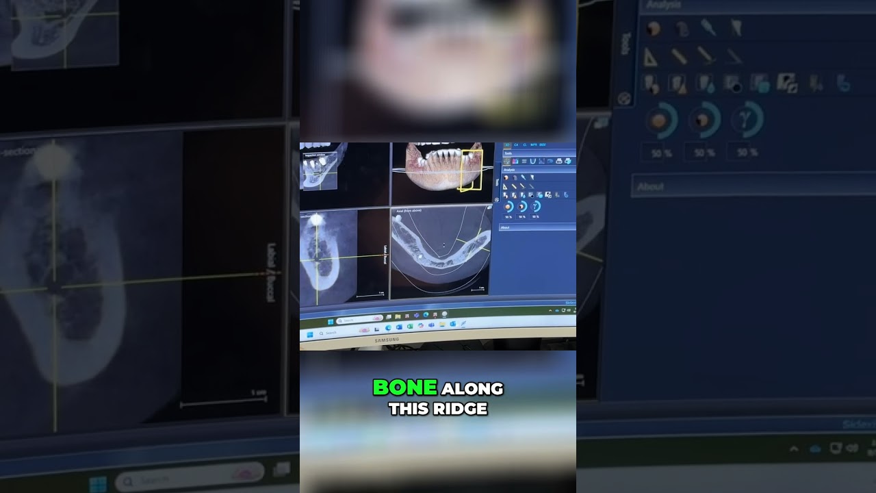 Dental Implant Bone Graft: Amazing X-Ray Transformation! 