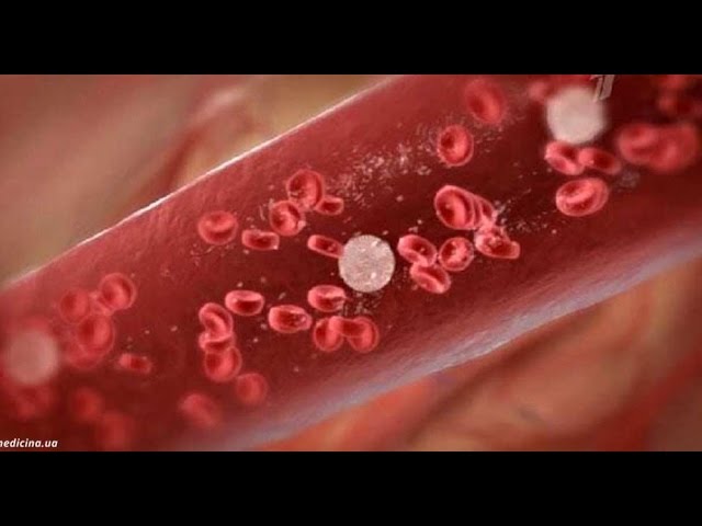 16 симптомов ЛЕЙКЕМИИ, о которых все почему то молчат!!