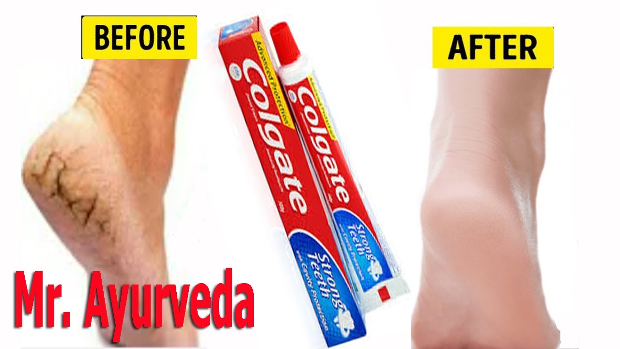 cracked heel treatments