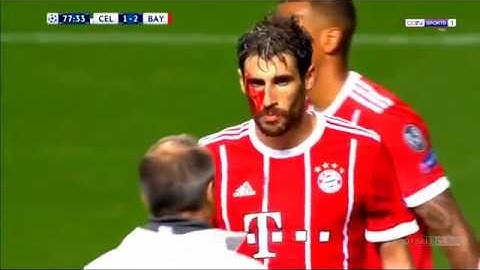 Celtic vs Bayern Munich 1-2  Goal & Highlights - Champions League 31/10/2017
