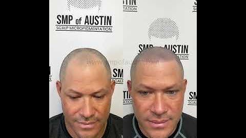 SMP of Austin - Scalp Micropigmentation Austin Texas Before and after video