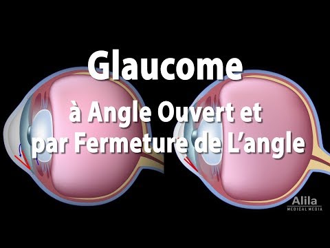 Pathologie du Glaucome, Animation