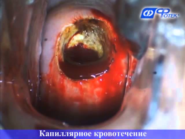 Радиоволновая конизация шейки матки