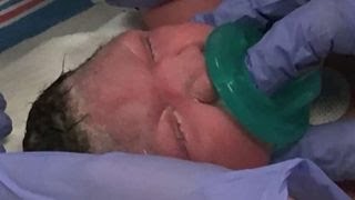 Baby Born With Zika-Related Birth Defect In Nj