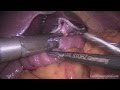 Laparoscopic rouxeny gastric bypass  live surgery