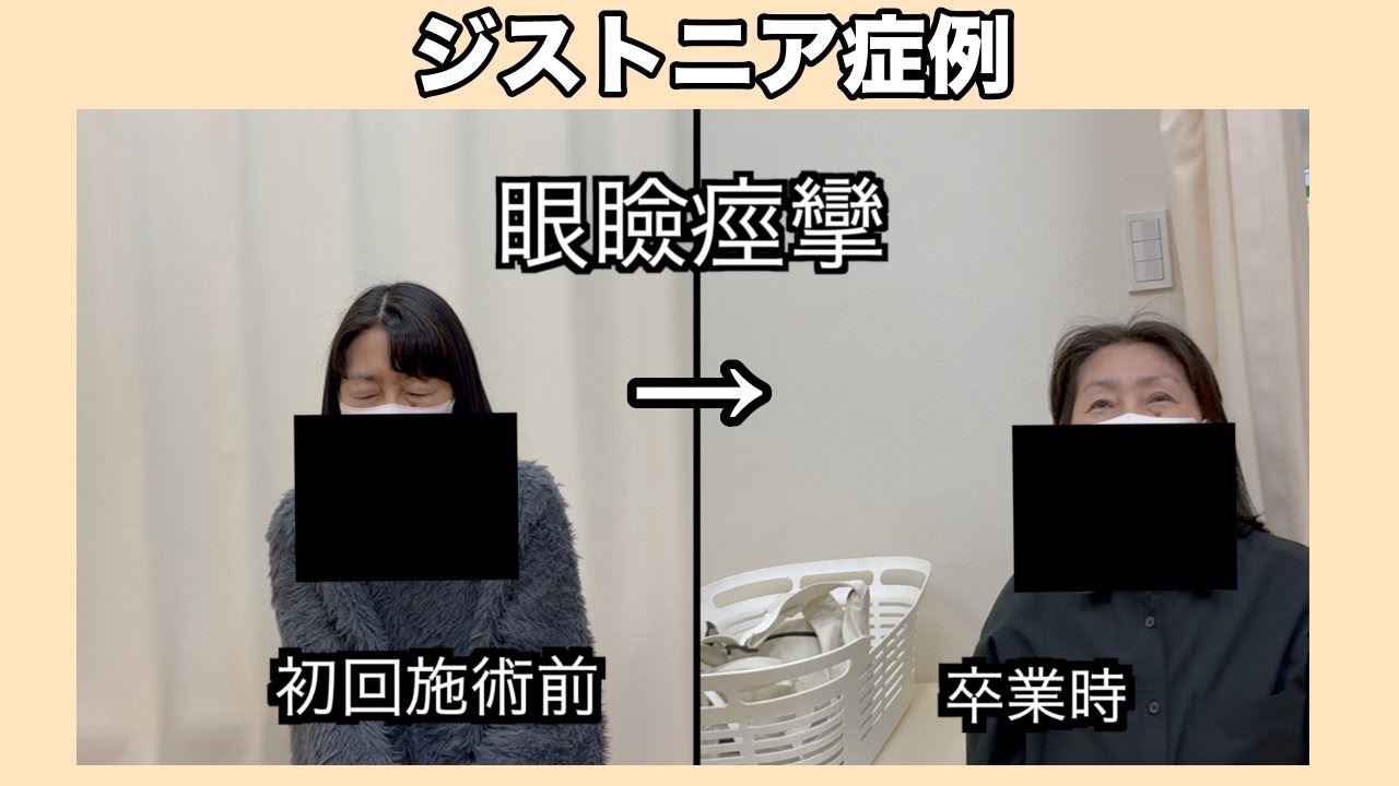 眼瞼痙攣(がんけんけいれん・ジストニア)と診断された女性の改善ビフォーアフター