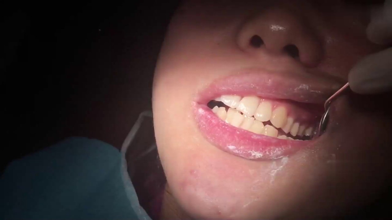 Ultrasonic teeth cleaning dental clinic cavity YouTube