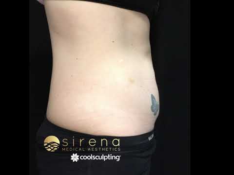 B+A CoolSculpting