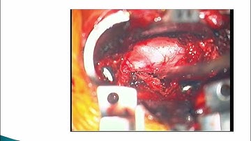AANS Coding Shorts: Introduction of the 63052 and 63053