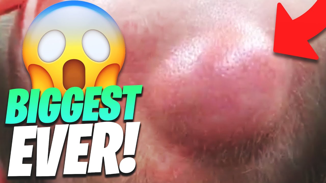 The biggest pimple pops from Dr. Pimple - YouTube