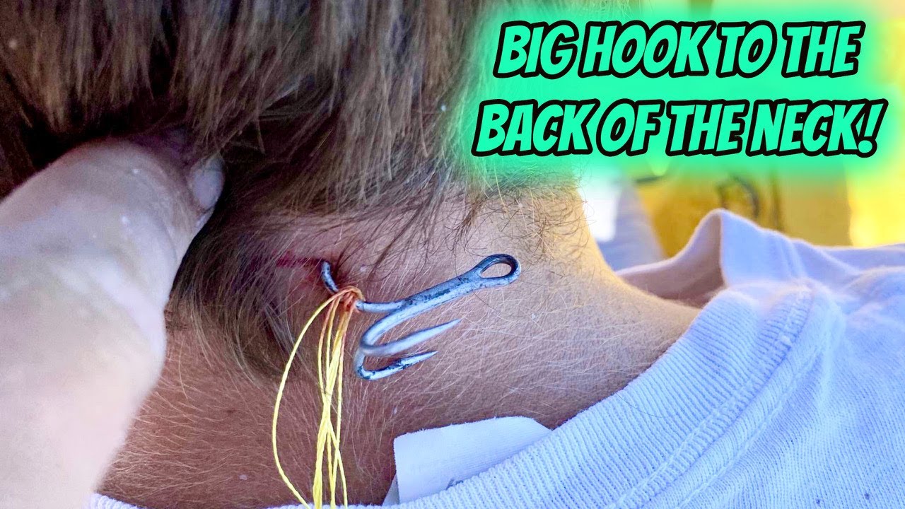 BIG HOOK gets STUCK in NECK & RIPPED OUT!