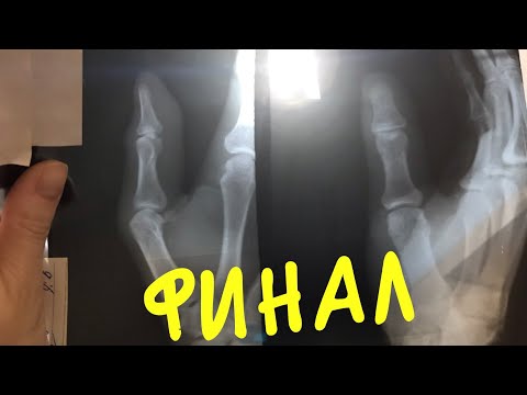 Маленькая история, большого пальца. Лангет.