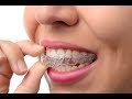 Clear aligners - Lapointe Dental Centres