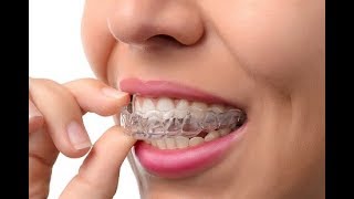 Clear aligners - Lapointe Dental Centres