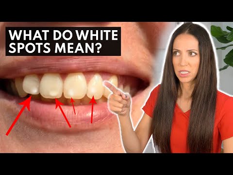 दांतों पर सफेद धब्बे क्या बता रहे हैं?