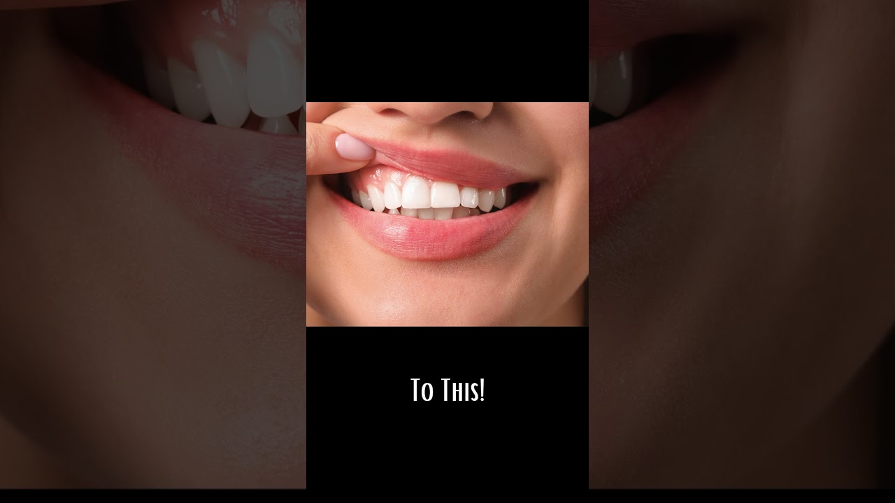 Take Prodentim supplement for teeth whitening and healthy teeth!