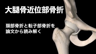 【医学】頚部骨折と転子部骨折を論文から読み解く・大腿骨近位部骨折