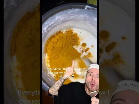 CRAZY DIY ACNE