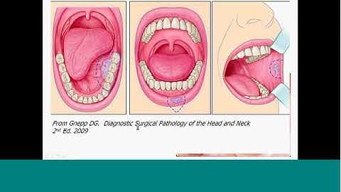 CAP education session Head and neck cancer Dr Perez Ordonez 2012