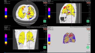 Covid 19 Analysis by Synapse 3D