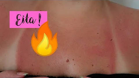 Quantos dias a pele descasca depois do sol?