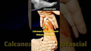 How to Calcaneal spur Myofascial Release! #painrelief #shorts #youtubeshorts #viral  #viralshorts