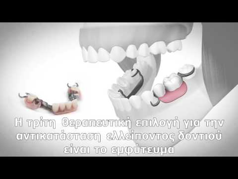 ioanna stasinopoulou   Επιλογές για αντικατάσταση ελλείποντος δοντιού