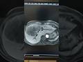 MRI of HBS Arterial Phase #MRI #HBS #MRIhbs #radiology