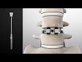 Overview Of Lumbar Disc Replacement Surgery With The M6-L