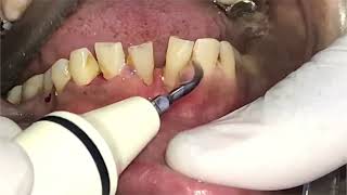 Scaling off pieces of teeth tartar