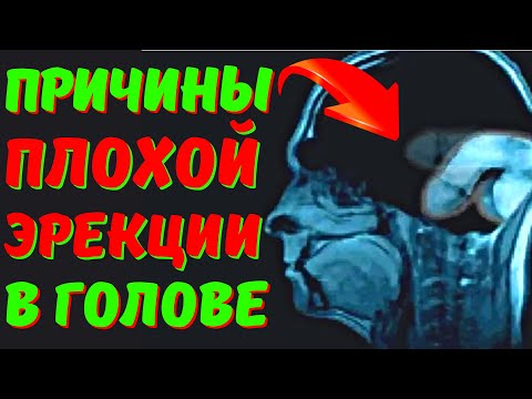 ПРОБЛЕМЫ С ЭРЕКЦИЕЙ ТОЛЬКО В ГОЛОВЕ. ПРИЧИНЫ СЛАБОЙ ЭРЕКЦИИ И КАК ИХ УСТРАНИТЬ. ПСИХОЭРЕКЦИЯ