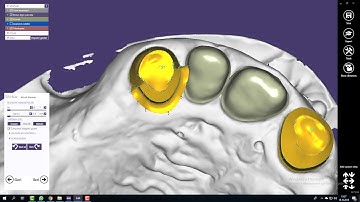 EXOCAD İNTER-LOCK FREZE DESİNG