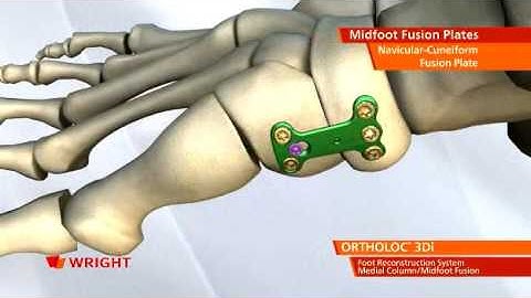 Wright - Ortholoc 3DI Medial Column Fusion Plates