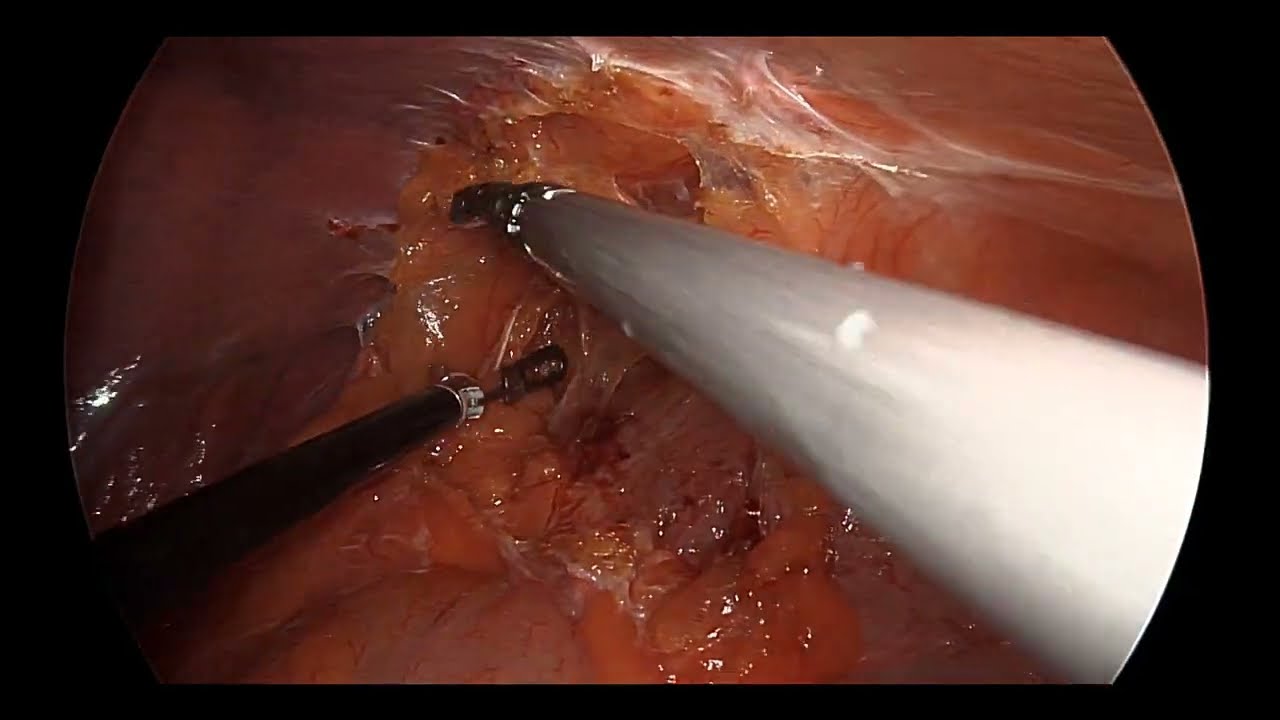 Laparoscopic left simple nephrectomy for non functional kidney with stone