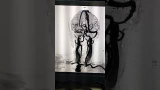 Brain angiography #travel