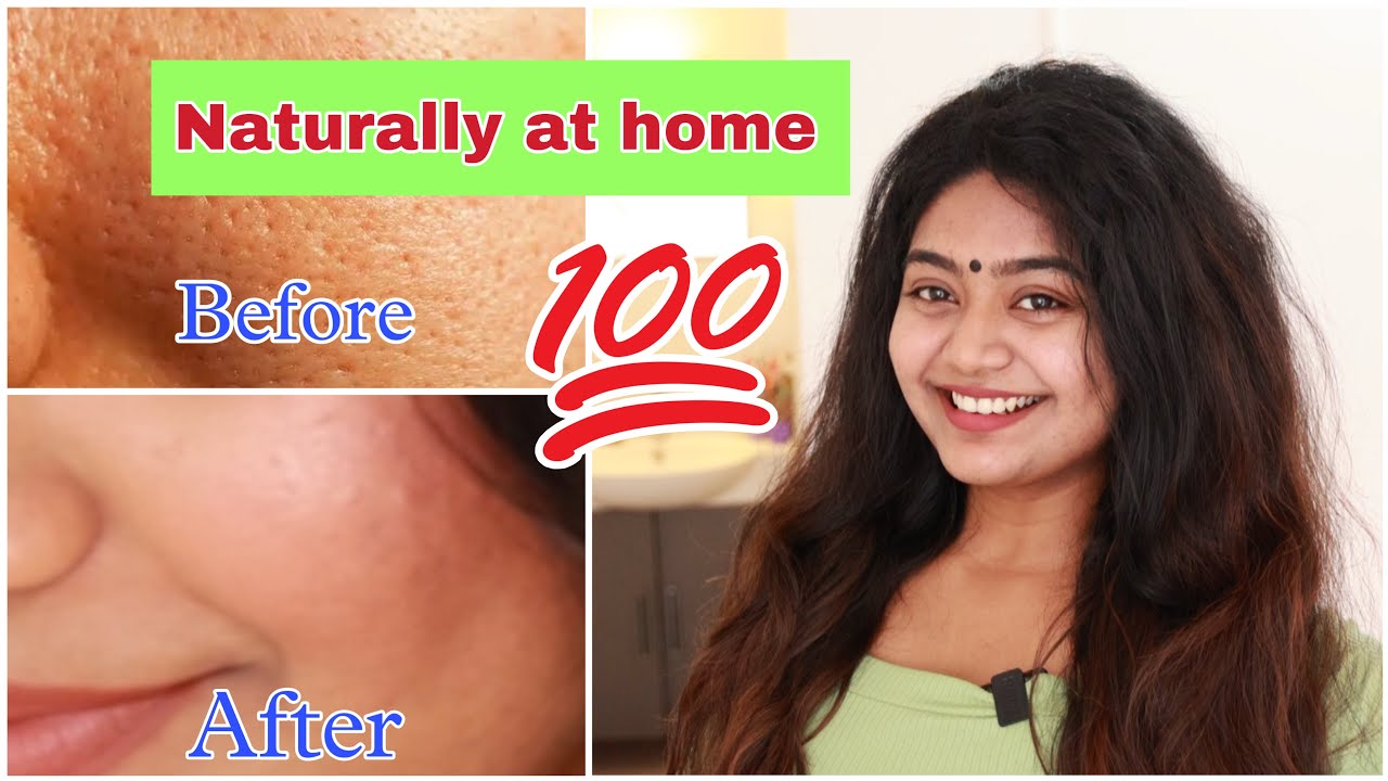 മുഖത്തെ കുഴികൾ മാറ്റാം എളുപ്പത്തിൽ _How to remove pores easily at home🌿